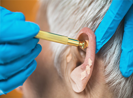 Auriculoterapia