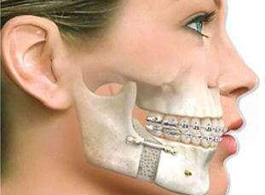 Prótese bucomaxilofacial