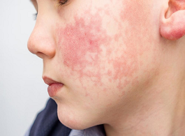 Alergia Alimentar Infantil